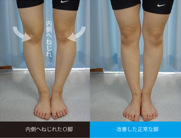 日本人に最も多い内ねじれO脚