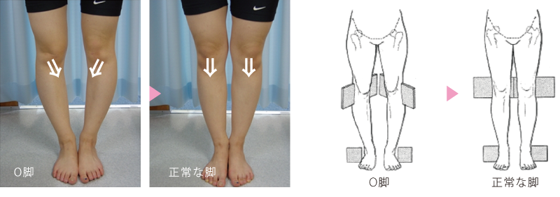O脚のメカニズムは脚が内向きの歪み
