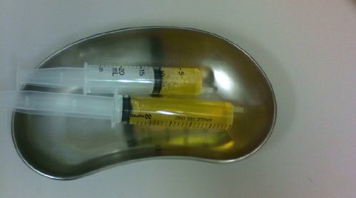 膝関節症の関節液