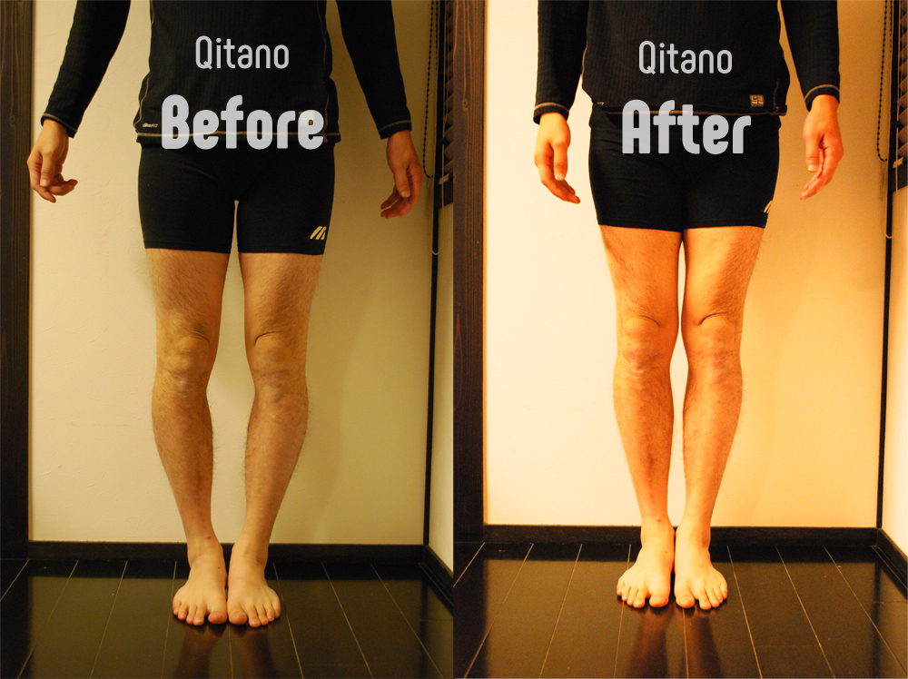 Qitano先生のO脚が改善ビフォーアフター