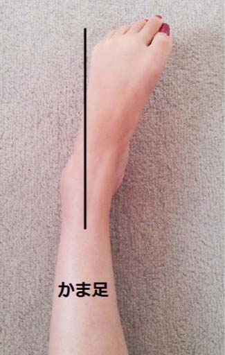 間違ったO脚矯正で鎌足になってしまう