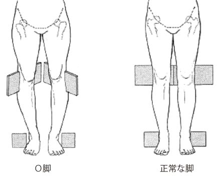 O脚のメカニズムイメージ画像